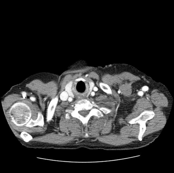 File:Autosomal dominant polycystic kidney disease (Radiopaedia 27851-28094 B 2).jpg