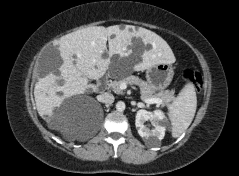 File:Autosomal dominant polycystic kidney disease (Radiopaedia 57124-64017 A 46).jpg
