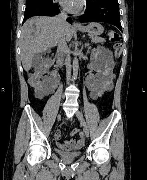 File:Autosomal dominant polycystic kidney disease (Radiopaedia 87830-104287 Coronal non-contrast 32).jpg