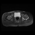 Avascular necrosis of the hip (Radiopaedia 29563-30067 Axial T2 fat sat 8).jpg