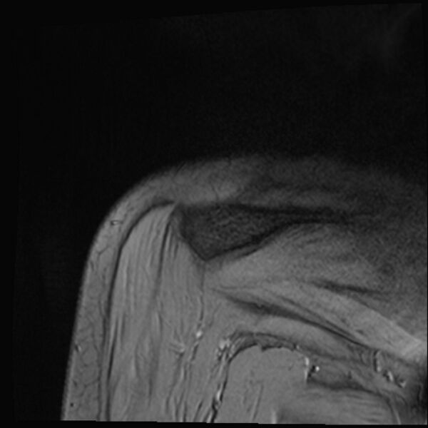 File:Avulsion fracture - greater tuberosity of humerus (Radiopaedia 71216-81515 Coronal T2 3).jpg