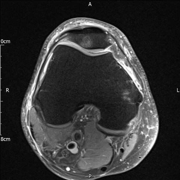 File:Avulsion fracture of the fibular head (Radiopaedia 74804-85808 Axial PD fat sat 13).jpg