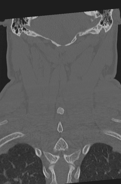 File:Axis peg fracture (type 3) and atlas lateral mass (type 4) fracture (Radiopaedia 37474-39324 Coronal bone window 45).png