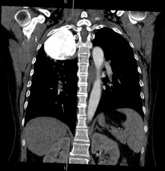 File:Azygos vein aneurysm (Radiopaedia 77824-90130 C 23).JPG