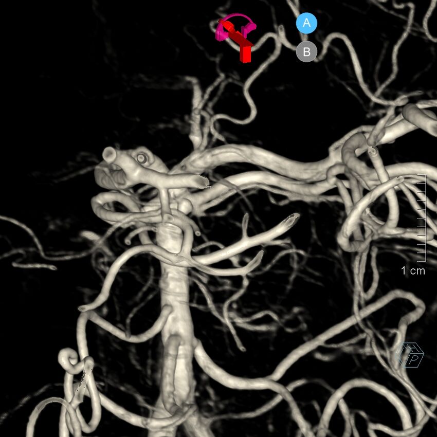 Basilar artery perforator aneurysm (Radiopaedia 82455-97734 3D view left VA 168).jpg