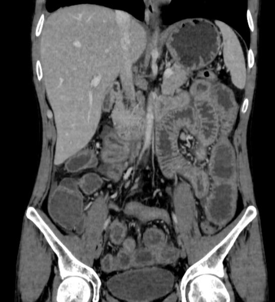 File:Behçet's disease- abdominal vasculitis (Radiopaedia 55955-62570 B 27).jpg