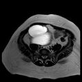 Benign seromucinous cystadenoma of the ovary (Radiopaedia 71065-81300 B 15).jpg