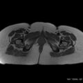 Bicornuate uterus- on MRI (Radiopaedia 49206-54297 Axial T1 18).jpg