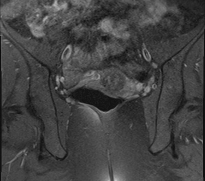 File:Bicornuate uterus (Radiopaedia 71214-81511 Coronal T1 fat sat 16).jpg