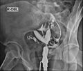 Bicornuate vs septate uterus (Radiopaedia 62784-71120 F 1).jpg