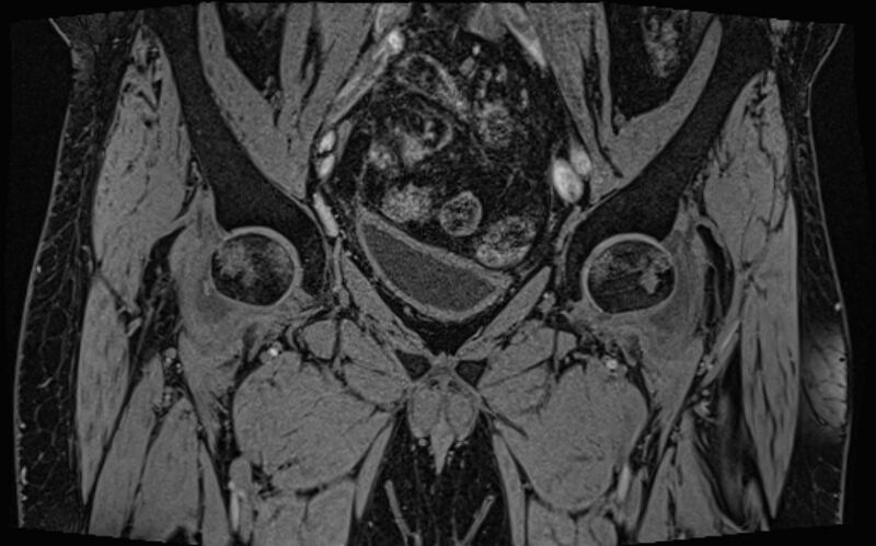 File:Bilateral avascular necrosis of femoral head (Radiopaedia 77116-89078 Coronal T2 we 62).jpg