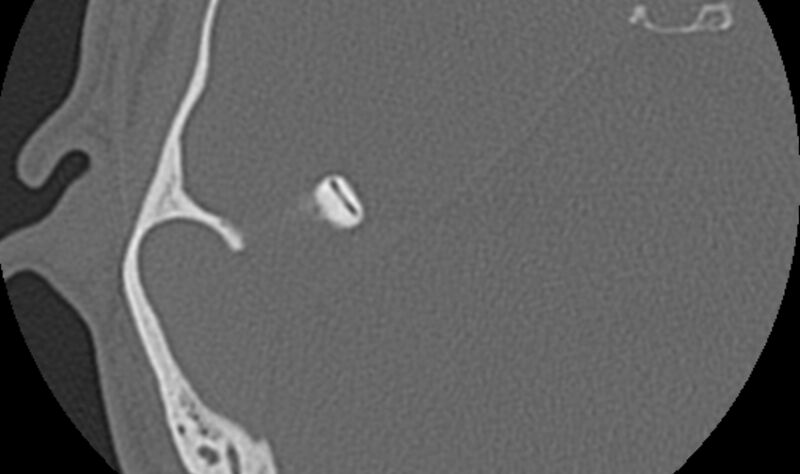 File:Bilateral cholesteatoma (Radiopaedia 54898-61172 Axial bone window 41).jpg