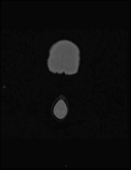 File:Bilateral frontal mucoceles (Radiopaedia 82352-96454 Coronal 9).jpg