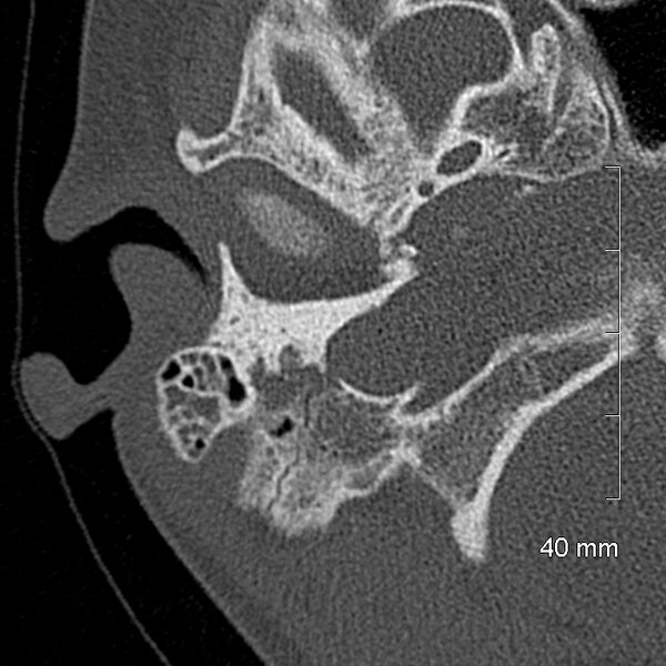 File:Bilateral grommets (Radiopaedia 47710-52404 Axial bone window 15).jpg