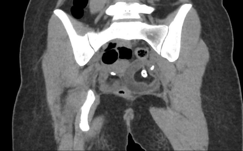 File:Bilateral mature cystic ovarian teratoma (Radiopaedia 88821-105592 Coronal non-contrast 26).jpg