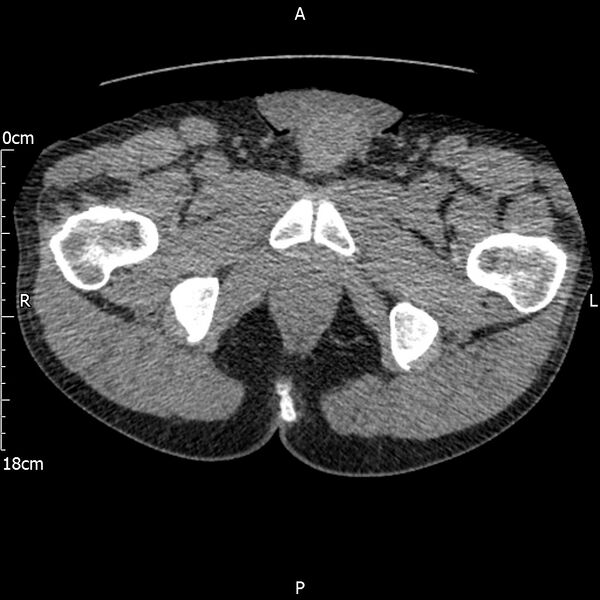 File:Bilateral medullary nephrocalcinosis with ureteric calculi (Radiopaedia 71269-81569 Axial non-contrast 140).jpg
