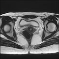 Bilateral ovarian endometriomas (Radiopaedia 87085-103347 Axial T2 15).jpg