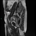 Bilateral ovarian fibroma (Radiopaedia 44568-48293 Sagittal T2 31).jpg