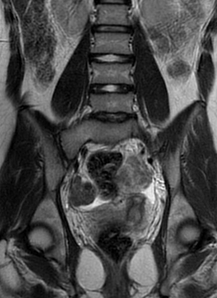 File:Bilateral ovarian fibrothecomas - adolescent (Radiopaedia 86604-102707 Coronal T2 21).jpg
