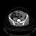 Bilateral ovarian mature cystic teratomas (Radiopaedia 79373-92457 Axial non-contrast 42).jpg