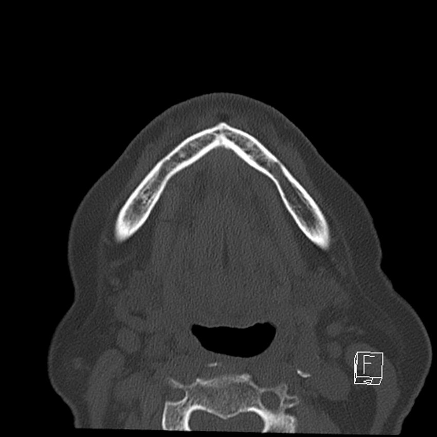 Bilateral palatine tonsilloliths on OPG and CT (Radiopaedia 75167-86247 Axial bone window 52).jpg
