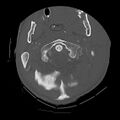 Bilateral perched facets with cord injury (Radiopaedia 45587-49713 Axial bone window 25).jpg