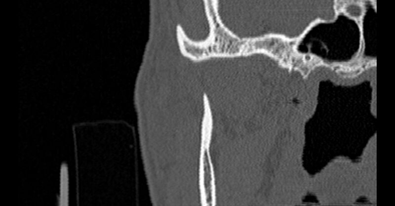 File:Bilateral temporal bone fractures (Radiopaedia 29482-29970 Coronal non-contrast 1).jpg