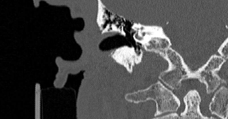 File:Bilateral temporal bone fractures (Radiopaedia 29482-29970 Coronal non-contrast 105).jpg