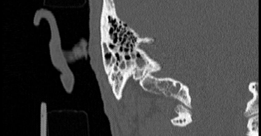 Bilateral temporal bone fractures (Radiopaedia 29482-29970 Coronal non-contrast 159).jpg