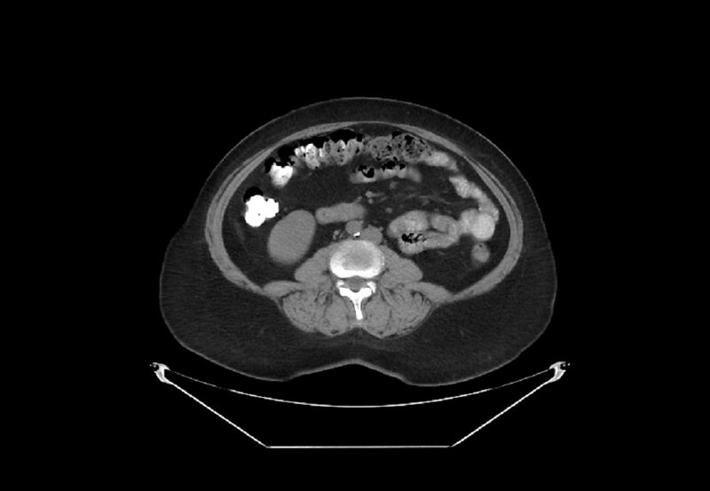 File:Bilateral urolithiasis with incidentally detected splenic artery aneurysm and left inferior vena cava (Radiopaedia 44467-48123 Axial non-contrast 30).jpg
