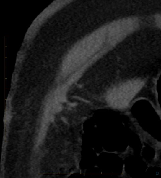 File:Bile leak from accessory duct(s) of Luschka post cholecystectomy (Radiopaedia 40736-43389 B 1).jpg