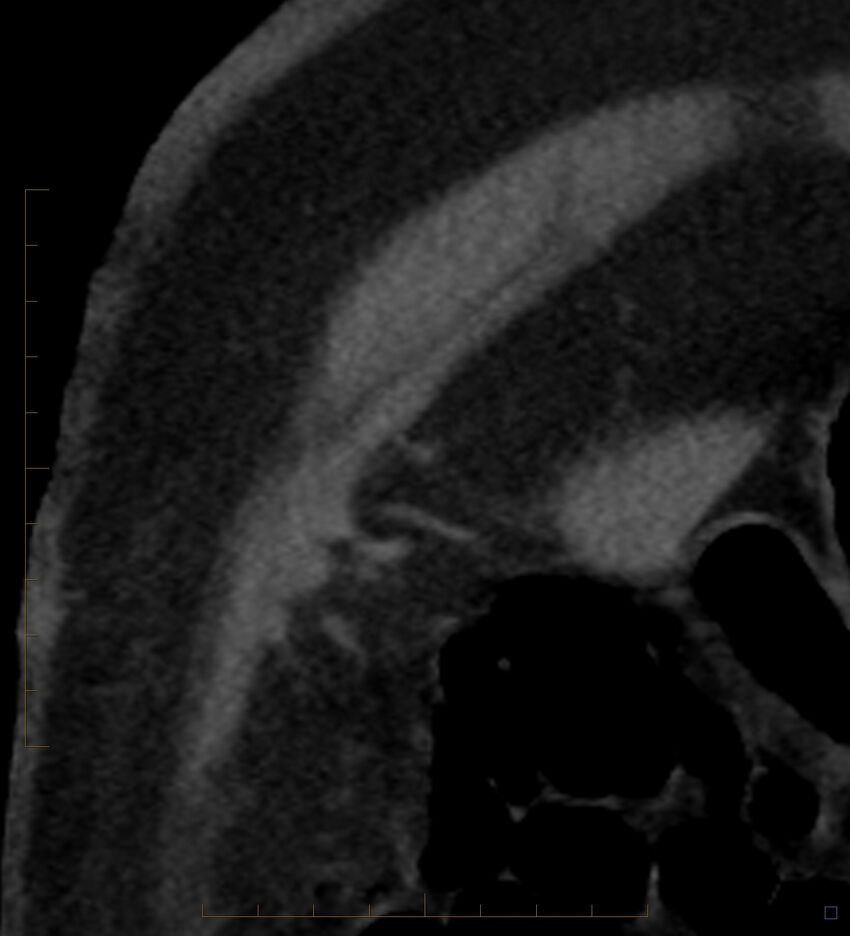 Bile leak from accessory duct(s) of Luschka post cholecystectomy (Radiopaedia 40736-43389 B 1).jpg