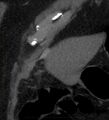 Bile leak from accessory duct(s) of Luschka post cholecystectomy (Radiopaedia 40736-43389 B 7).jpg