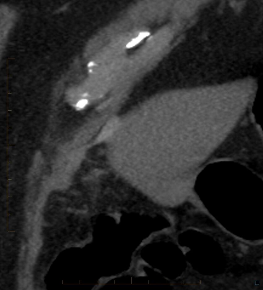 Bile leak from accessory duct(s) of Luschka post cholecystectomy (Radiopaedia 40736-43389 B 7).jpg