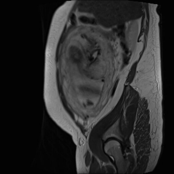File:Bilobed placenta accreta (Radiopaedia 69648-79591 Sagittal T2 33).jpg