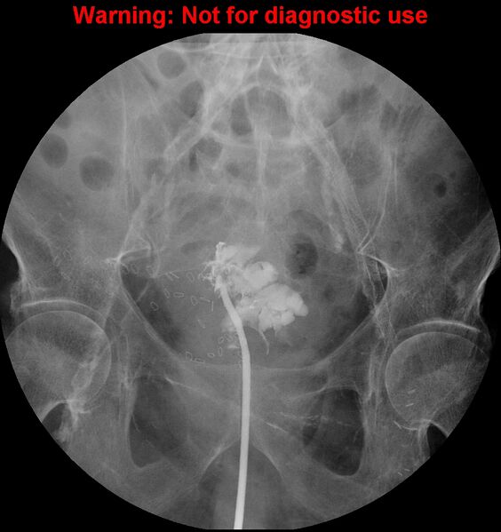 File:Bladder rupture (intraperitoneal) (Radiopaedia 41057-43807 cystogram 2).jpg