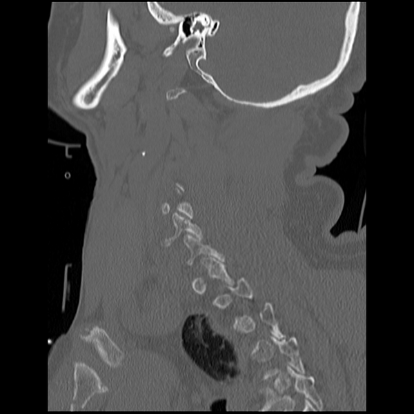 File:Blunt cerebrovascular injury (Radiopaedia 53682-59743 Sagittal bone window 18).png
