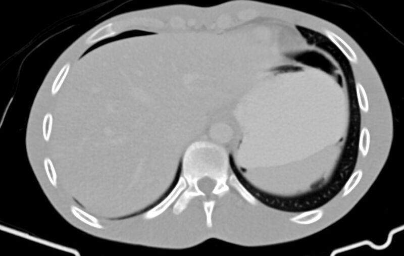 File:Blunt injury to the small bowel (Radiopaedia 74953-85987 Axial Wide 5).jpg