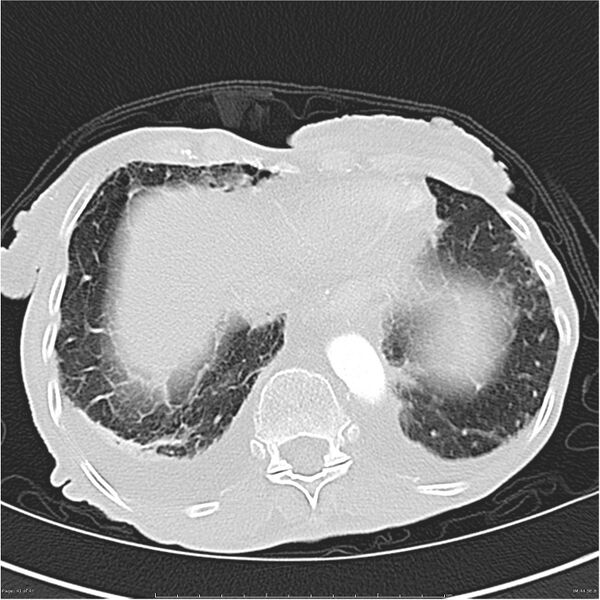 File:Boerhaave syndrome (Radiopaedia 26240-26362 Axial lung window 41).jpg
