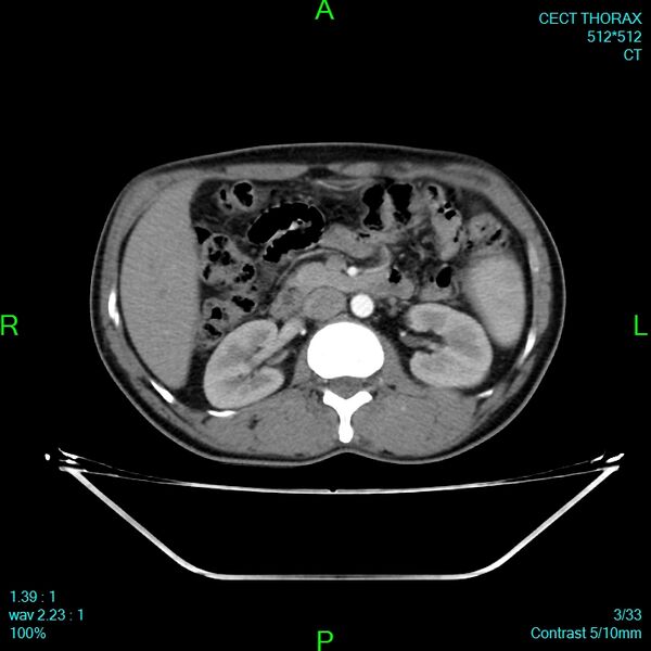 File:Bone metastases from lung carcinoma (Radiopaedia 54703-60937 Axial C+ delayed 3).jpg