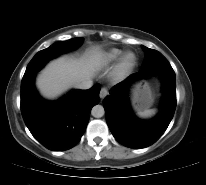 File:Bosniak renal cyst - type IV (Radiopaedia 22929-22953 D 4).jpg