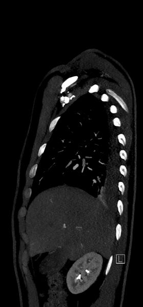 File:Brachiocephalic trunk pseudoaneurysm (Radiopaedia 70978-81191 C 24).jpg