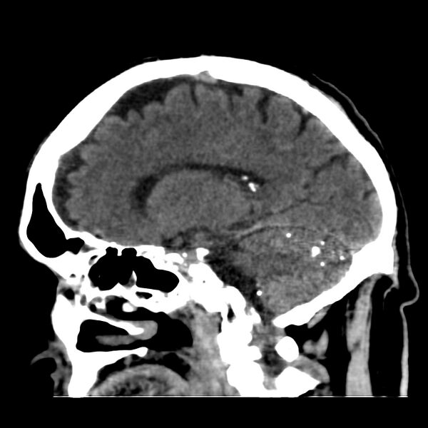 File:Brain Pantopaque remnants (Radiopaedia 78403-91048 C 34).jpg