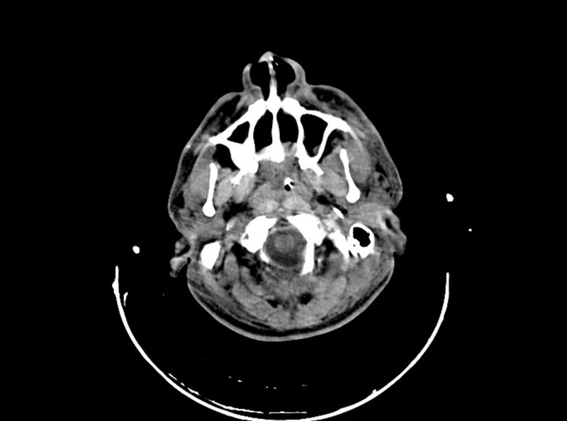 File:Brain injury by firearm projectile (Radiopaedia 82068-96087 B 40).jpg