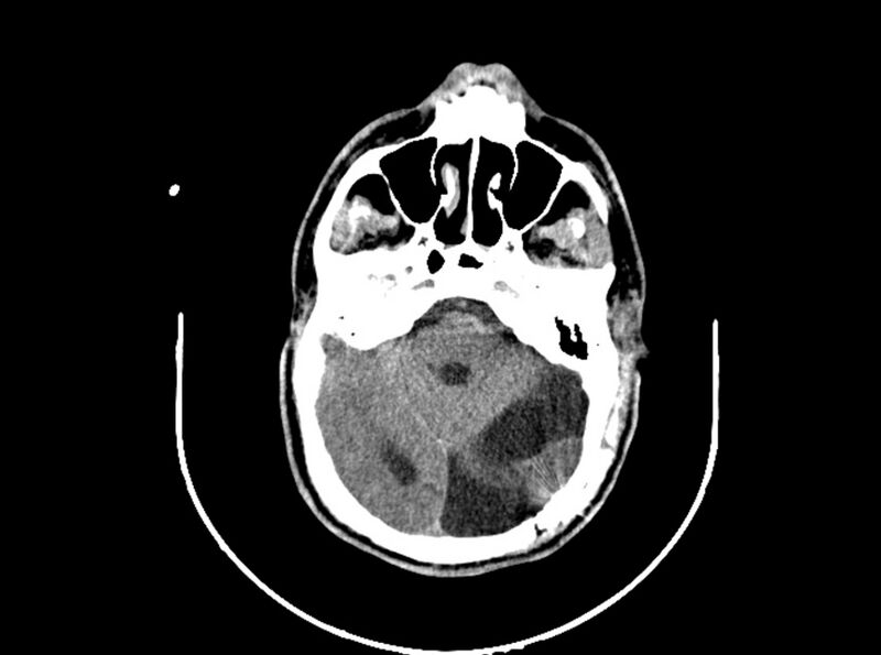 File:Brain injury by firearm projectile (Radiopaedia 82068-96088 A 95).jpg