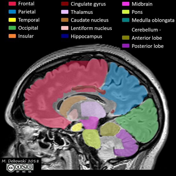 File:Brain lobes - annotated MRI (Radiopaedia 61691-69700 Sagittal 46).JPG