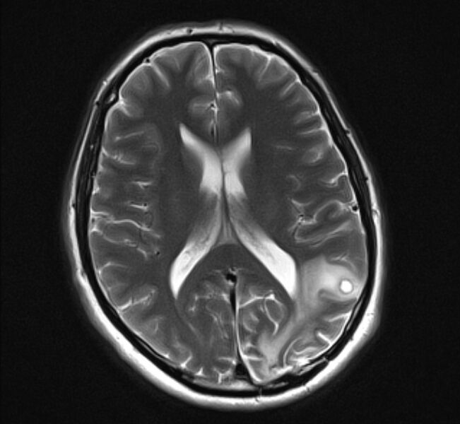 File:Brain metastases - lung cancer primary (Radiopaedia 75060-86115 Axial T2 15).jpg