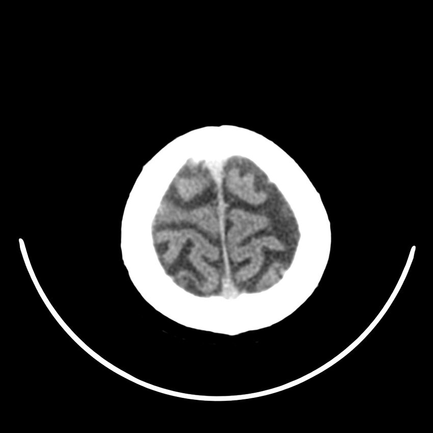 Brain metastasis (Radiopaedia 42617-45760 Axial non-contrast 48).jpg
