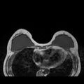 Breast implants - MRI (Radiopaedia 26864-27035 Axial T1 20).jpg