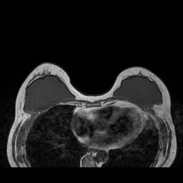 File:Breast implants - MRI (Radiopaedia 26864-27035 Axial T1 20).jpg